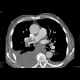 Lung embolism, massive: CT - Computed tomography